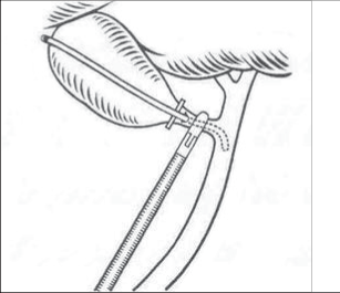Obr. 12b – Nástřih ductus cysticus, zavedení katétru a peroperační cholangiografie