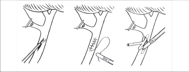 Obr. 14 – Choledochotomie, sutura choledochu bez T-drénu, zavedení T-drénu