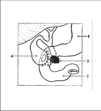 Obr. 15 – Cholecystoduodenoanastomóza; 1 – žaludek 2 – duodenum 3 – blokující nádor 4 – žlučník