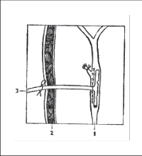 Obr. 17 – Drenáž choledochu T-drénem – uložení drénu a sutura choledochotomie; 1 – hepatocholedochus 2 – stěna břišní 3 – T-drén