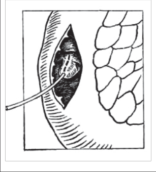 Obr. 18 – Papilosfinkterotomie po otevření stěny duodena (schéma řezu papily na zavedené sondě)