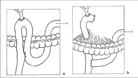 Obr. 19 – Hepatikojejunoanastomóza a) s enteroenteroanastomózou podle Brauna (1 – klička orální), b) s enteroenteroanastomózou podle Rouxe (1 – klička orální)