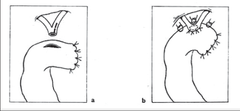 Obr. 21 – Anastomóza hilová a) rozšíření žlučovodu nástřihem levého hepatiku, b) po založení anastomózy s kličkou jejuna