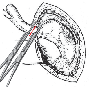 Obr. 2 – Odstranění apendixu po podvazu mezenteriola