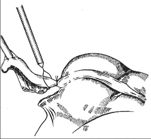 Obr. 7 – Oddělení apendixu po naložení tří kliček „endo-loop“