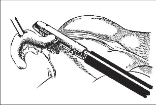 Obr. 8 – Stapler „Endo GIA 30 mm“ k oddělení apendixu
