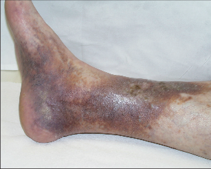 Obr. 3 – Chronická žilní insuficience ve stadiu C4 (CVI C4) s pigmentovými změnami kůže