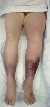 Obr. 9 – Phlegmasia coerulea dolens na konci léčby