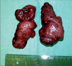 Obr. 4a – Operační preparát odstraněných obou laloků štítné žlázy (Thyreoidectomia totalis)