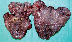 Obr. 4b – Thyreoidectomia near totalis (n TTE) , na řezu je patrná uzlovitá struktura obou laloků