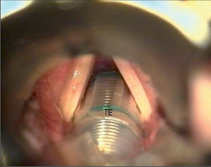 Obr. 8b – Po intubaci pak pásková elektroda registruje a dále přenáší stah hlasivky – pohled do laryngu po intubaci
