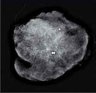 Obr. 3f – Nález mikrokalcifikací v duktálním karcinomu in situ před operací II.
