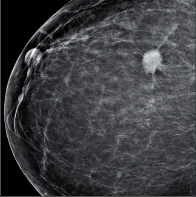Obr. 3e – Mamografický nález karcinomu II.