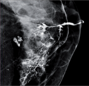 Obr. 5 – Duktografie prsu