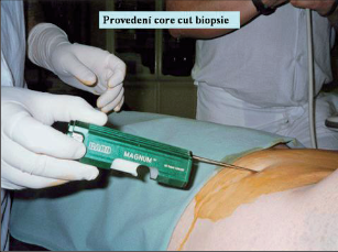 Obr. 6 – Core cut biopsie