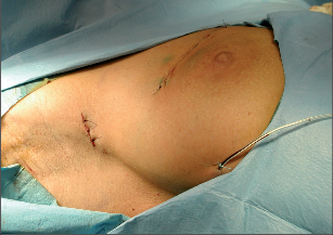 Obr. 9 – Stav po prs záchovné operaci a biopsii sentinelové uzliny