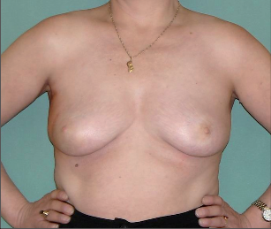 Obr. 8 – Pacientka po prs záchovné operaci – I.