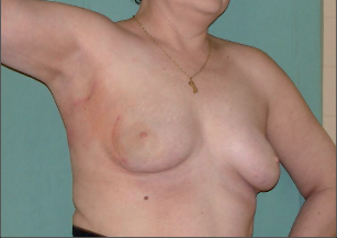 Obr. 8 – Pacientka po prs záchovné operaci – II.