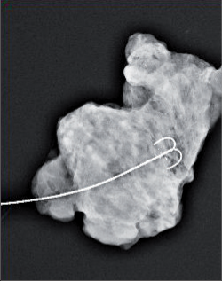 Obr. 10 – Exstirpované ložisko po označení drátkem stereotakticky pro nehmatnou lézi (mamografie odstraněného operačního preparátu)
