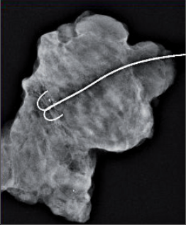 Obr. 10 – Exstirpované ložisko po označení drátkem stereotakticky pro nehmatnou lézi (mamografie odstraněného operačního preparátu)
