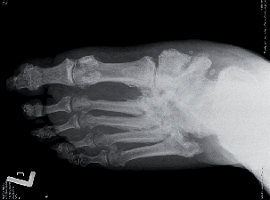  Charcotův kloub, skelet nohy I.