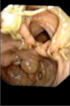 Obr. 9 – Rektální forma m. Crohn