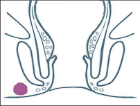 Obr. 3 – Podkožní perianální absces