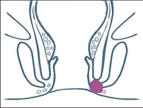 Obr. 5 – Podkožní marginální absces