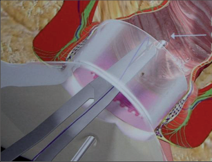 Obr. 24 – Vnitřní ústí nasondováno fistuloskopem, zachyceno suturou