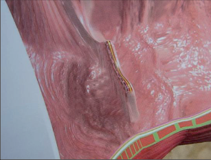 Obr. 27 – Staplerová sutura