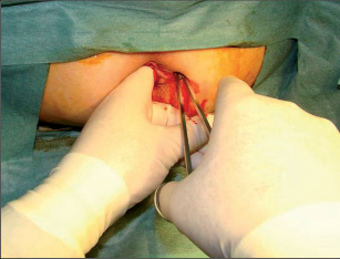 Obr. 89 – Po otočení o 90 stupňů prostříháváme musculus sphincter ani internus v délce 25 mm