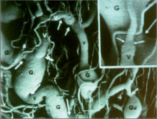 Obr. 95 – Corpus cavernosum recti – AV shunt