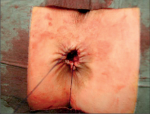 Obr. 140 – Provedená cikulární sutura