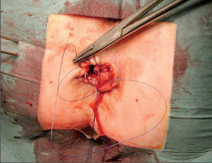 Obr. 139 – Mukokutánní sutura pokračujícím stehem